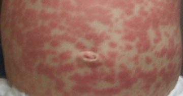 Measles case confirmed in ACT as authorities list possible exposure sites